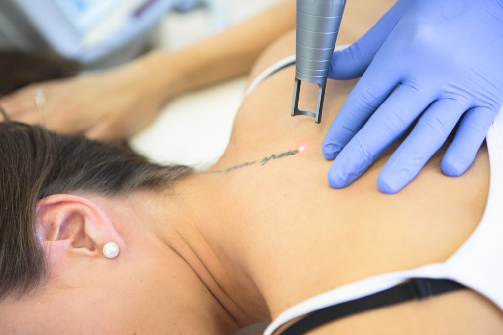 Détatouage laser